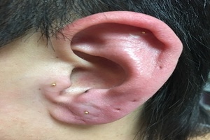 耳ツボ療法（花粉症）