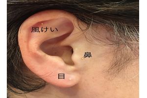 花粉症対策の耳ツボ