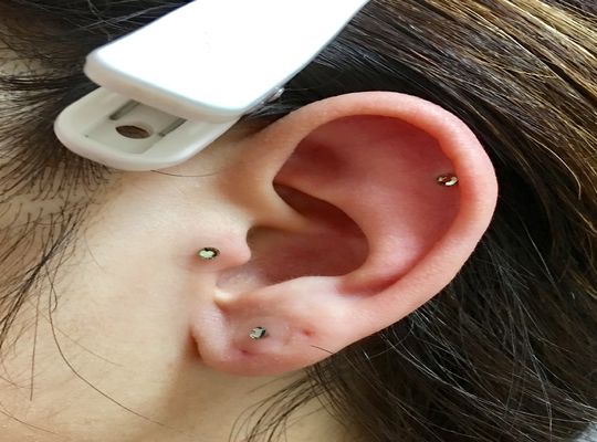 花粉症対策の耳つぼ